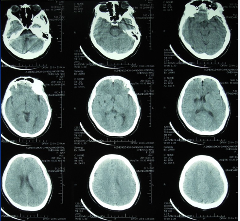 mri示:左侧基底节区急性脑梗塞,右侧基底节区脑软化灶,双侧大脑中动脉