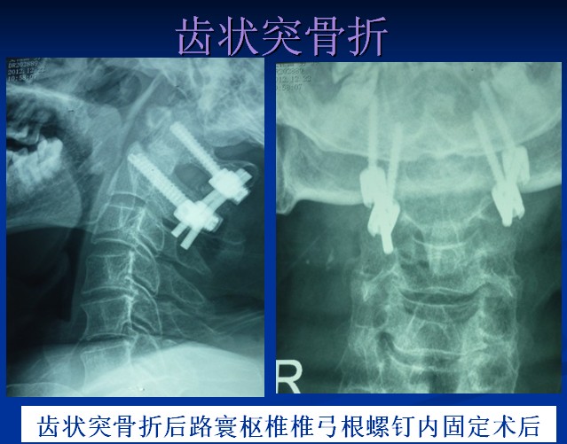 主要症状为四肢肢麻木,无力,不能行走,经过颈后路寰枢椎椎弓根内固定