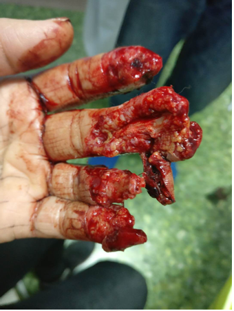 左手手指疼痛缓解,二期行腹部带蒂皮瓣创面修复术,术后患者左手部皮瓣